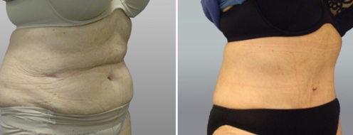 Tummy tuck before and after, patient 3, angle view