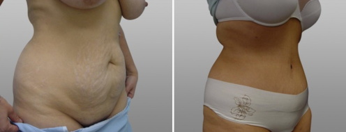 Tummy Tuck Photos 34 Abdominoplasty (Tummy Tuck) with Dr Norris, before and after photos post-op 6 weeks, patient 35