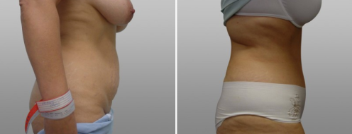 Before and after tummy tuck, patient 35, side view