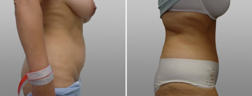 Tummy Tuck Photos 33 Abdominoplasty (Tummy Tuck) before and after photos post-op 6 weeks, patient 35, side view