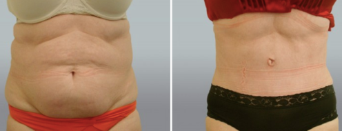 Tummy Tuck Photos 32 Abdominoplasty (Tummy Tuck) before and after photos post-op 6 weeks, patient 36, front view