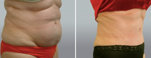 Tummy Tuck Photos 31 Abdominoplasty (Tummy Tuck)before and after photos post-op 6 weeks, patient 36, side view