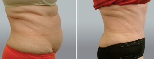 Before and after tummy tuck, Form & Face Sydney, patient 36
