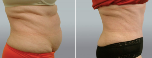 Tummy Tuck Photos 30 Abdominoplasty (Tummy Tuck) before and after photos post-op 6 weeks, Form & Face Sydney, patient 36