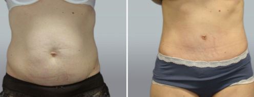 Tummy Tuck Photos 29 Patient 37, Abdominoplasty (Tummy Tuck) before and after photos post-op 6 weeks, front view