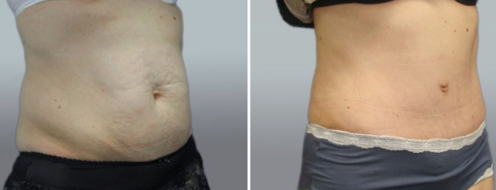Tummy Tuck Photos 28 Abdominoplasty (Tummy Tuck) before and after photos post-op 6 weeks, patient 37, angle view