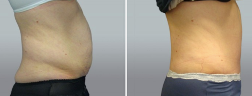 Tummy Tuck Photos 27 Dr Norris, Abdominoplasty (Tummy Tuck) patient 37, side view, before and after photos post-op 6 weeks