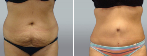 Tummy Tuck Photos 26 Abdominoplasty (Tummy Tuck) before and after photos post-op 6 weeks, image gallery, patient 38, front view
