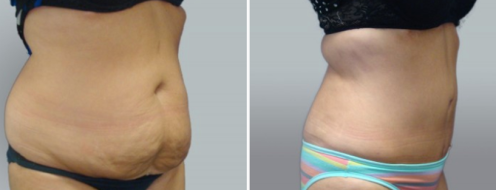 Before and after tummy tuck, patient 38, angle view