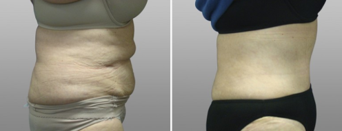Tummy tuck patient 3, before & after surgery, side view