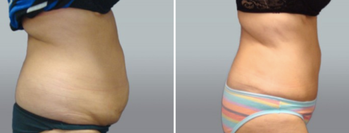 Tummy Tuck Photos 24 Abdominoplasty (Tummy Tuck) surgery, patient 38, side view, before and after photos post-op 6 weeks