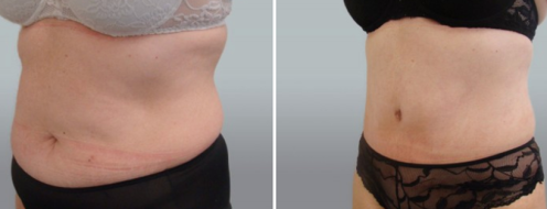 Tummy Tuck Photos 23 Abdominoplasty (Tummy Tuck) patient 39, angle view, before and after photos post-op 6 weeks