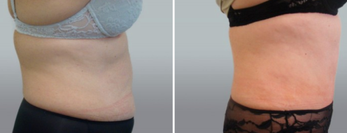Tummy Tuck Photos 22 Abdominoplasty (Tummy Tuck) , patient 39, side view, before and after photos post-op 6 weeks