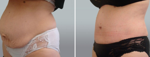 Patient before and after tummy tuck surgery, Dr Norris, image 93