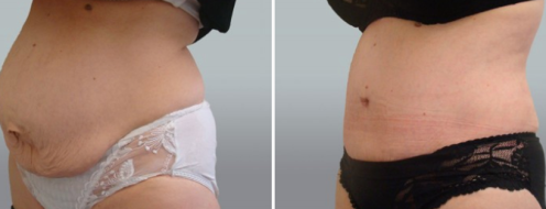 Tummy Tuck Photos 21 Patient Abdominoplasty (Tummy Tuck) surgery before and after photos post-op 6 weeks, Dr Norris, image 93