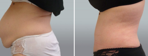 Tummy Tuck Photos 20 Abdominoplasty (Tummy Tuck) patient 40, before and after photos post-op 6 weeks, side view