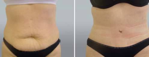 Tummy Tuck Photos 19 Patient 42 Abdominoplasty (Tummy Tuck) before and after photos post-op 6 weeks, image 95, front view