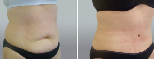 Tummy Tuck Photos 18 Abdominoplasty (Tummy Tuck) before and after photos post-op 6 weeks, patient 42, image 96, angle view
