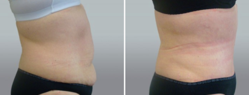 Tummy Tuck Photos 17 Patient Abdominoplasty (Tummy Tuck) before and after photos post-op 6 weeks, 97, side view