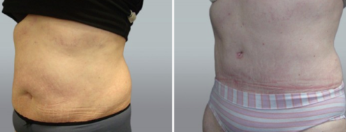 Tummy Tuck Photos 16 Abdominoplasty (Tummy Tuck) images, patient 43, angle view, before and after photos post-op 6 weeks