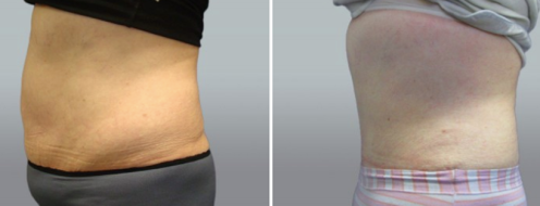 Tummy Tuck Photos 15 Abdominoplasty (Tummy Tuck) results, patient 43, image 99, side view, before and after photos post-op 6 weeks