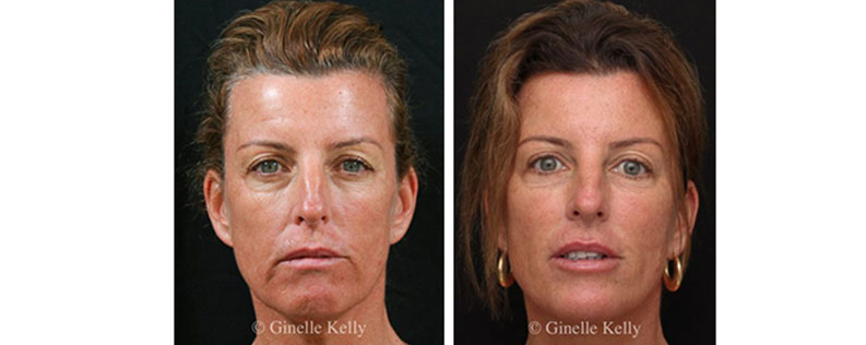 Dermal fillers before and after 02, Form & Face