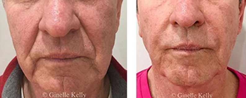 Dermal fillers before & after 05, naso-labial folds, front view