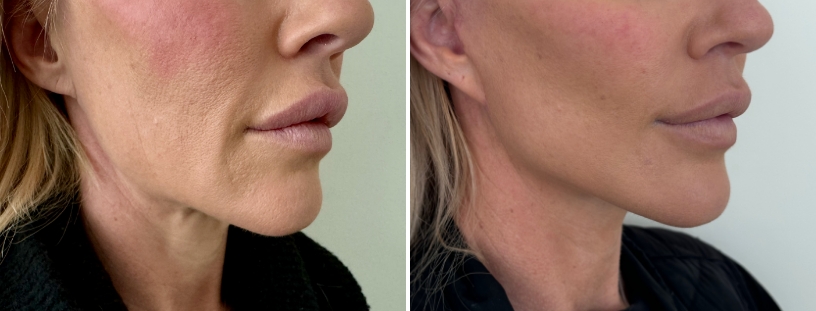 Facelift Surgery | 3