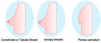 Breast Surgery for Tuberous Breasts