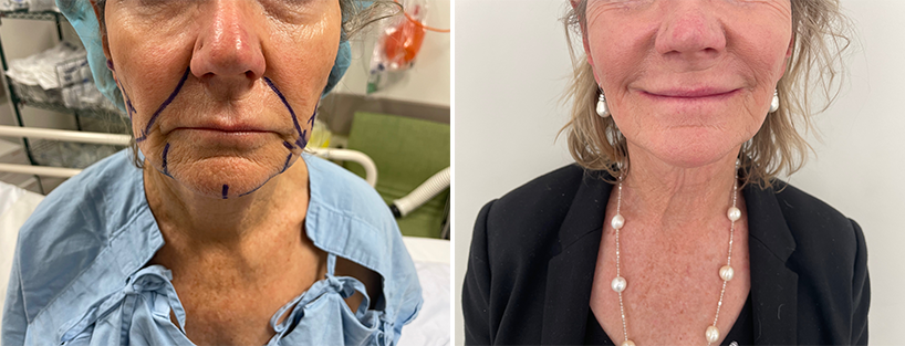 Facelift Surgery | 2