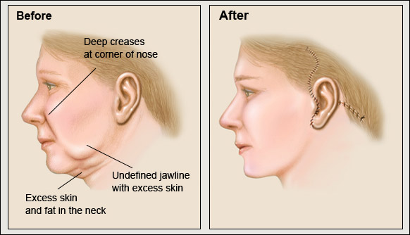 Before and after facelift surgery illustration