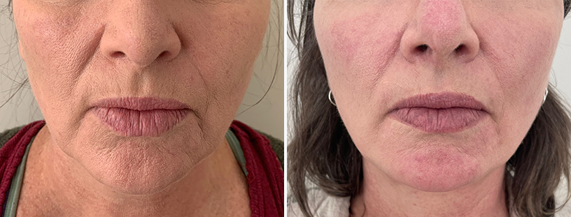 Facelift Surgery | 1