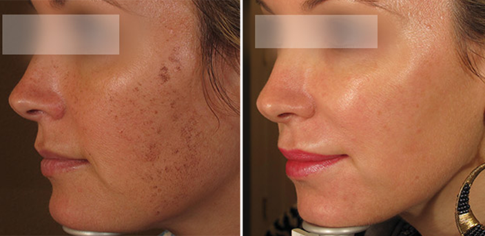 BBL treatment before and after 01, Form & Face Sydney