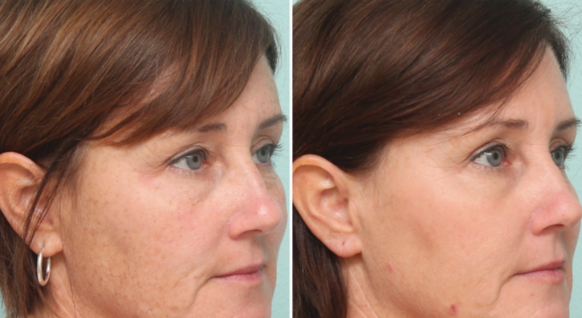 Micropeel before and after 04
