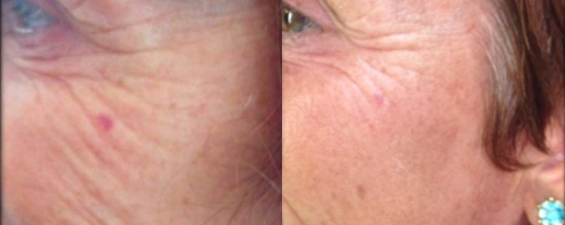 PRP Therapy Results, 12 Weeks Post PRP, Form & Face