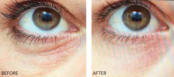 Beauty booster for lower eyelids, before and after 03, Form & Face