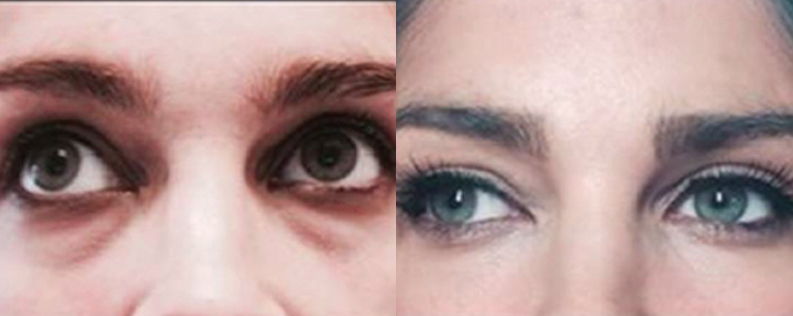 PRP therapy before and after 03 (6 month post treatment)