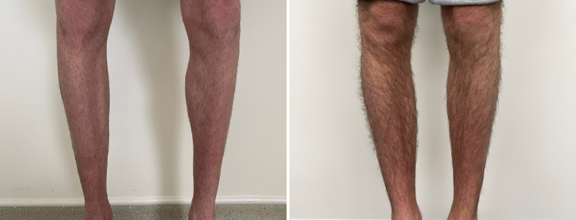 Calf Implants (Calf Augmentation) Sydney | 1