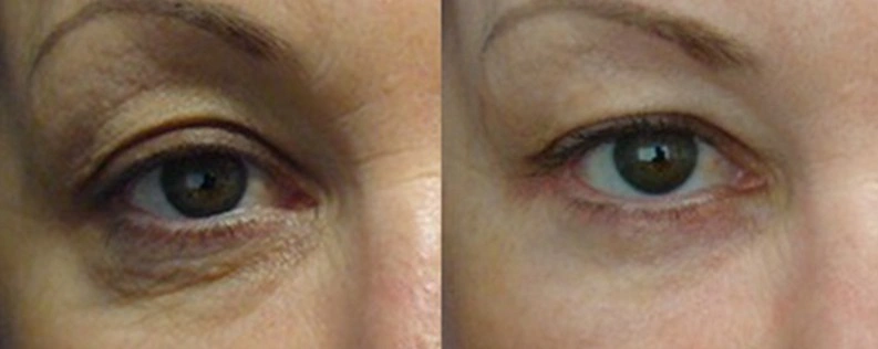 Blepharoplasty gallery, a female patient before and after procedure 03