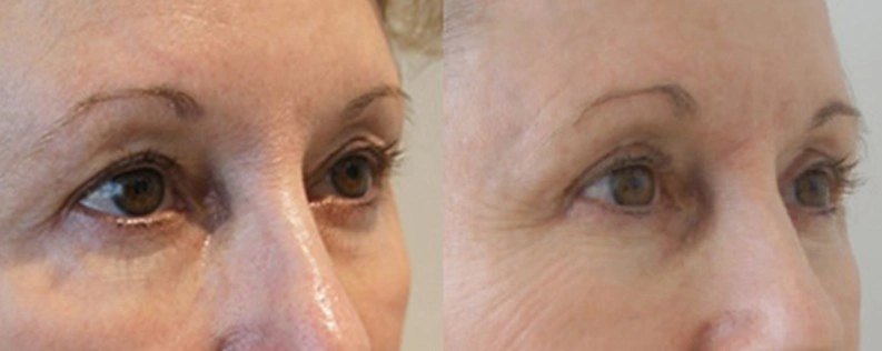 Blepharoplasty (eyelid surgery) 04, Dr Norris - Form & Face