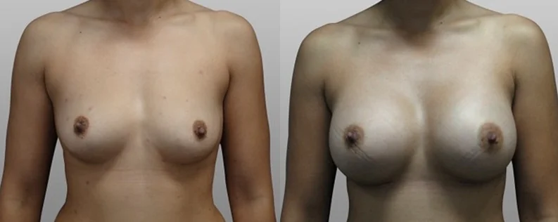 Breast augmentation in Sydney, before and after 11, Dr Ben Norris