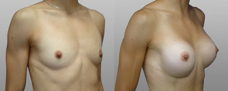 Breast augmentation before and after 12
