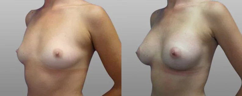 Breast implants surgery before and after 13
