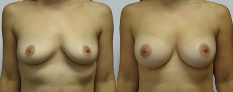Boob job before and after 14, Dr Norris Sydney