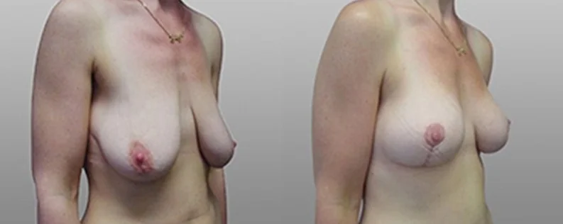 Mastopexy Surgery | 1