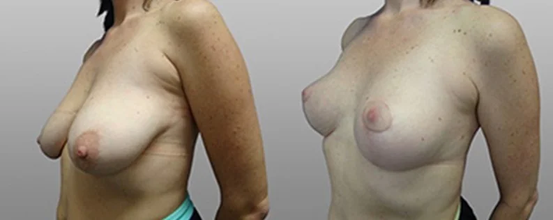 Mastopexy Surgery | 2