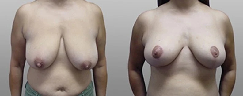 Mastopexy Surgery | 4