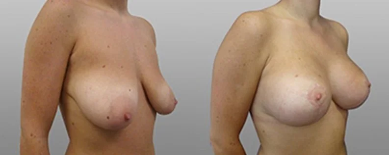 Breast Lift with Implants | 1