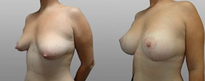 Breast Lift with Implants | 2