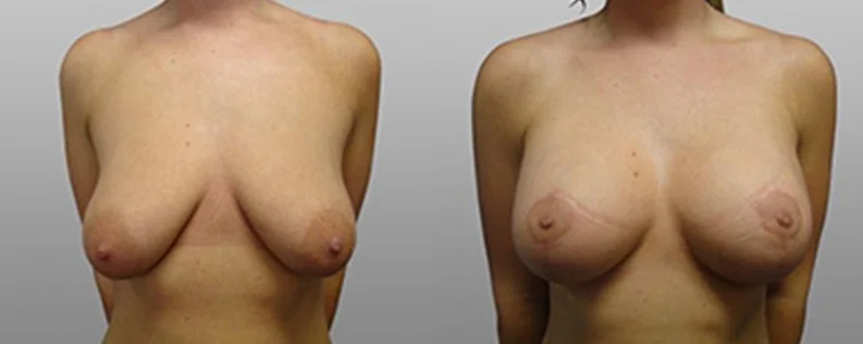 Breast Lift with Implants | 3